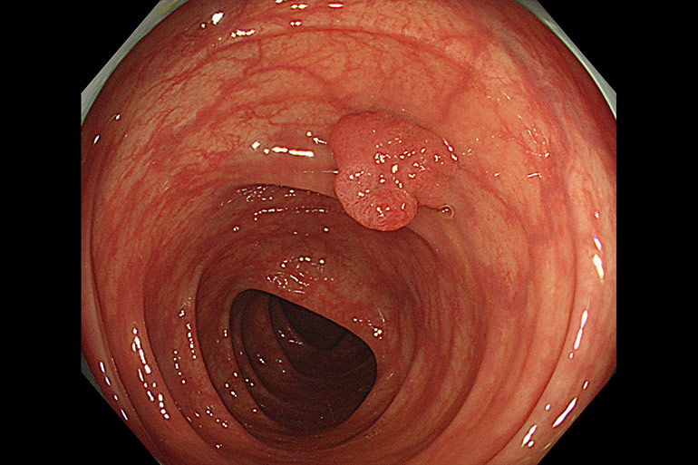 大腸ポリープは血便・便潜血陽性の原因