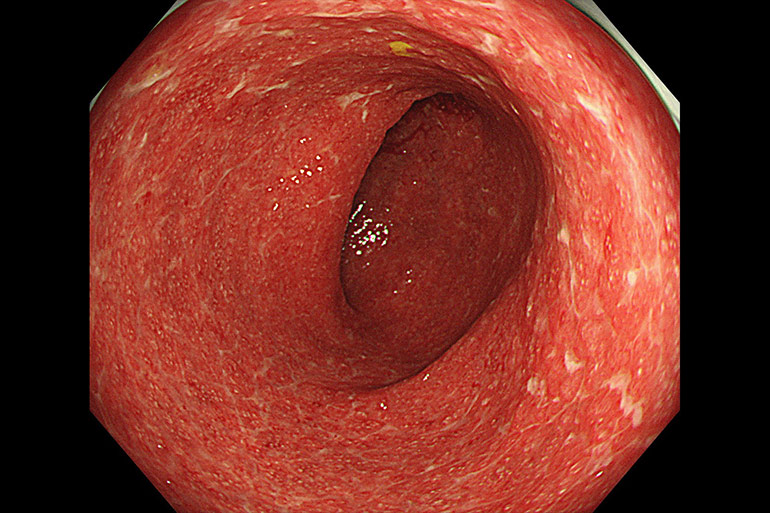 潰瘍性大腸炎は血便・便潜血陽性の原因