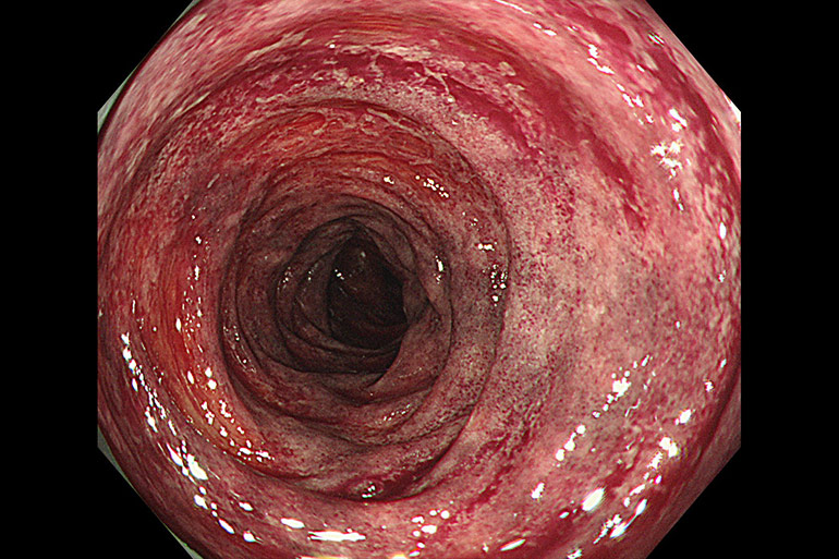 虚血性大腸炎は血便・便潜血陽性の原因