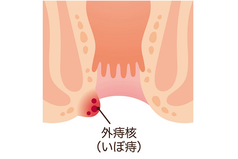 血便 便潜血陽性で陽性の原因 にしやま消化器内科