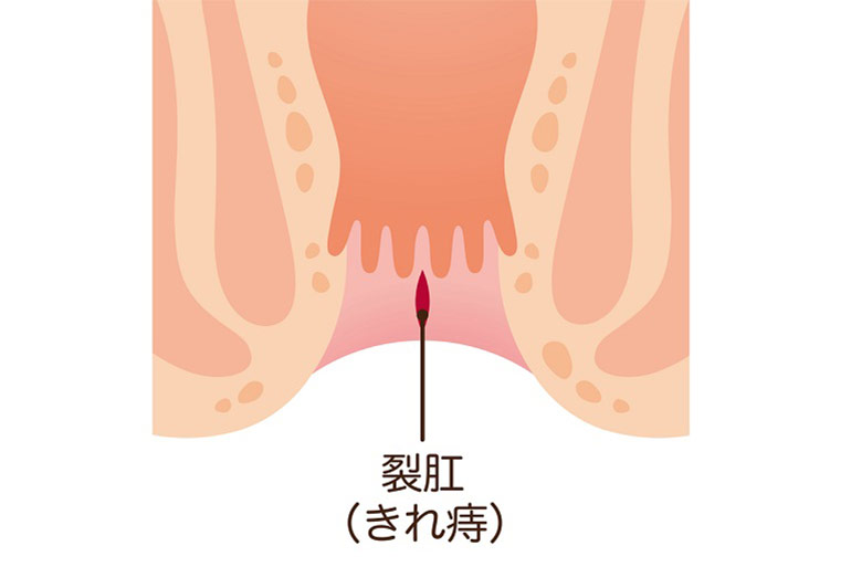 切れ痔は血便・便潜血陽性の原因