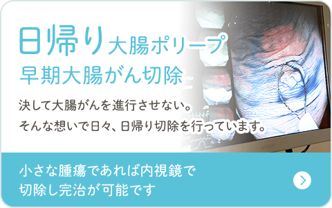 日帰り大腸ポリープ 早期大腸がん切除