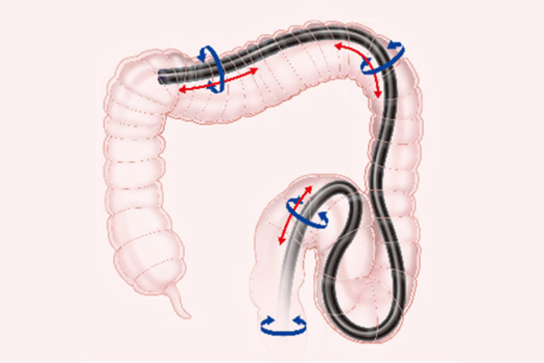 挿入時も痛くない大腸内視鏡検査なら大阪のにしやま消化器内科