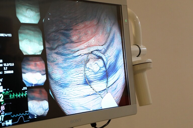 日帰り大腸ポリープ切除