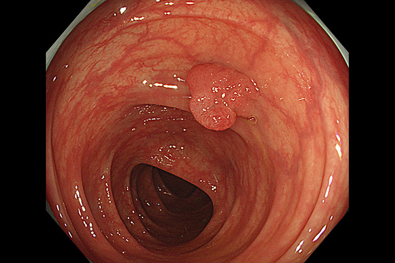 大腸ポリープについて