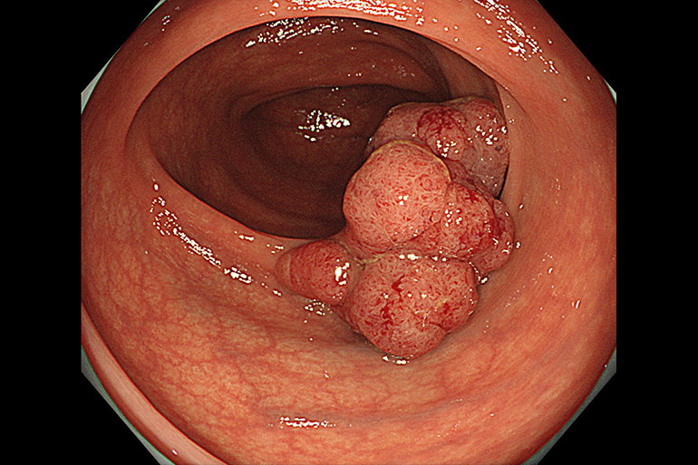 早期大腸がんについて