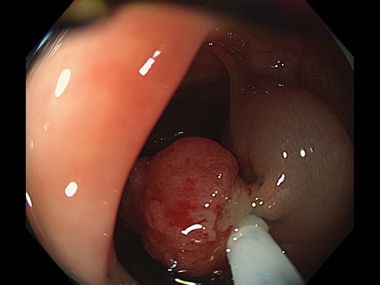 内視鏡的粘膜切除術（EMR）