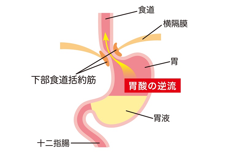 逆流性食道炎の原因