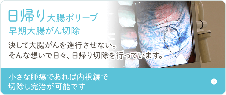 日帰り大腸ポリープ 早期大腸がん切除