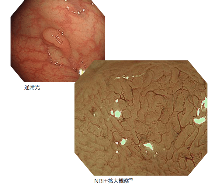 NBI（挟帯域光観察）システムを搭載し、がんを正確に効率よく発見