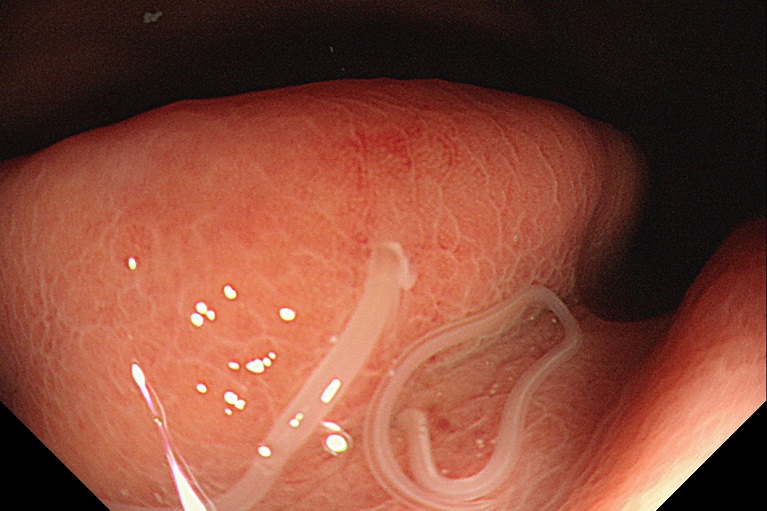 アニサキスはどういう症状なの？アニサキスは冷凍すると問題ないの 