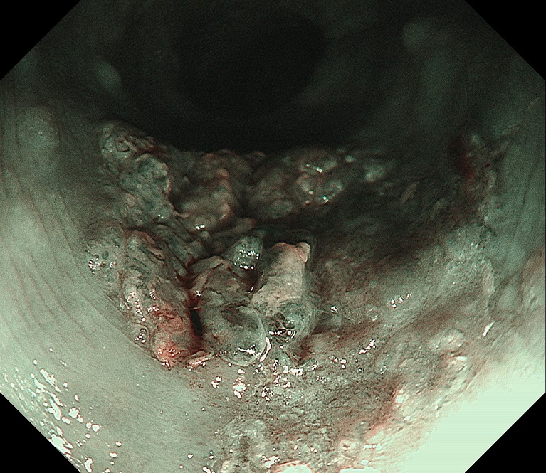 深い層まで及んでいる進行食道がん（NBI画像）